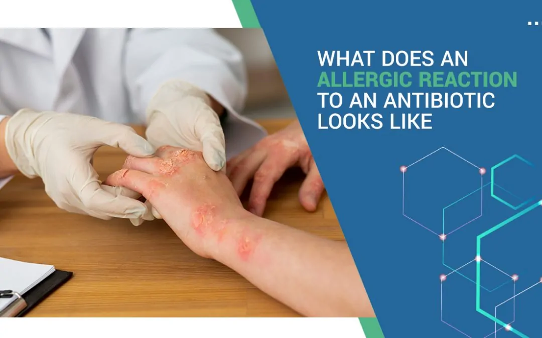 What does an allergic reaction to an antibiotic look like